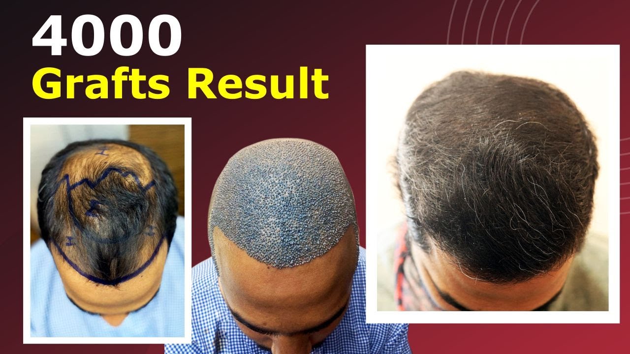 Hairfree  Hairgrow Patient Hair Journey