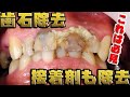 歯石除去&接着剤も除去🦷去除牙石&粘合剂 tartar remove&adhesive