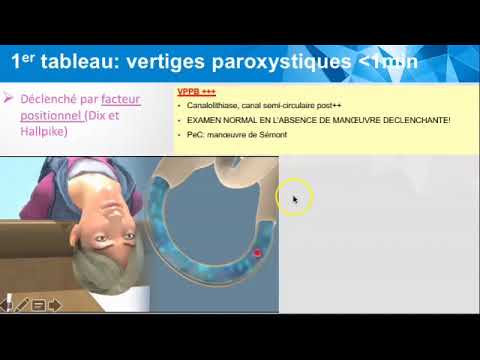 Vidéo: Vertige Périphérique: Types, Diagnostic Et Traitements