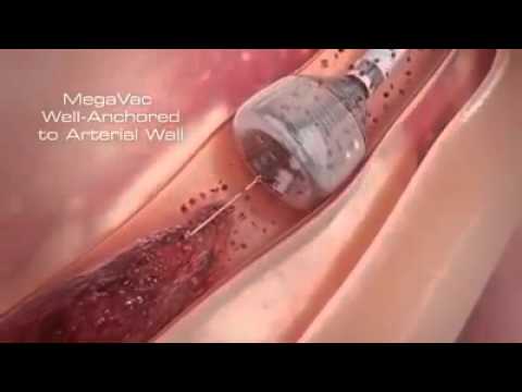 PCI Tanpa Ring (Stent) - Untuk Jantung Koroner - YouTube