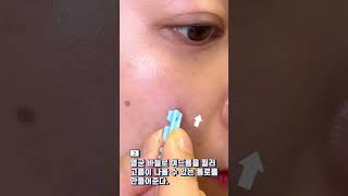 여드름 흉터 없이 짜는 법 #shorts #여드름압출 집에서 하세요‼️