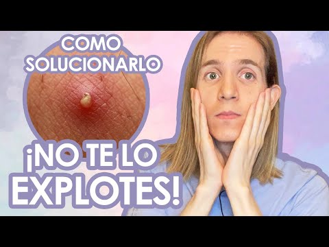 Vídeo: Pus Espinillas: Qué Es, Cómo Tratar Y Prevenir