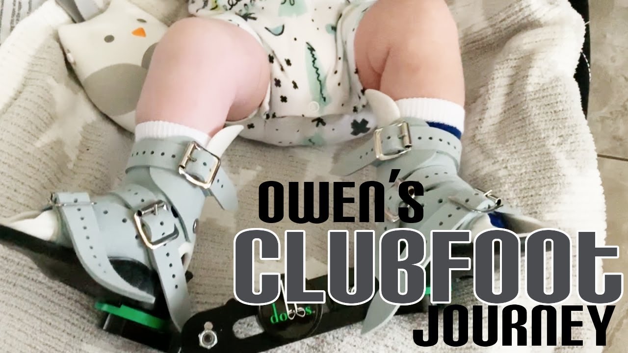 Baby Owen's Clubfoot Journey | Pangani Tribe