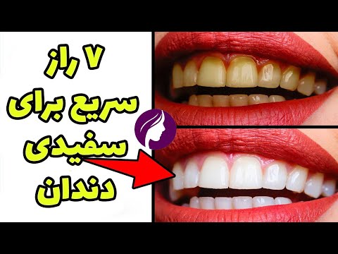 تصویری: سفید کردن حرفه ای دندان چقدر است؟