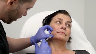 Facial Sculpting with Belotero Balance Soft Dermal Filler | Facial Rejuvenation by Dr. Jason Emer screenshot 2