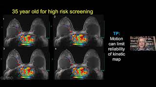 Breast MRI – Lesion Analysis and Interpretation, Dr. Priscilla Slanetz - MRI Online Noon Conference