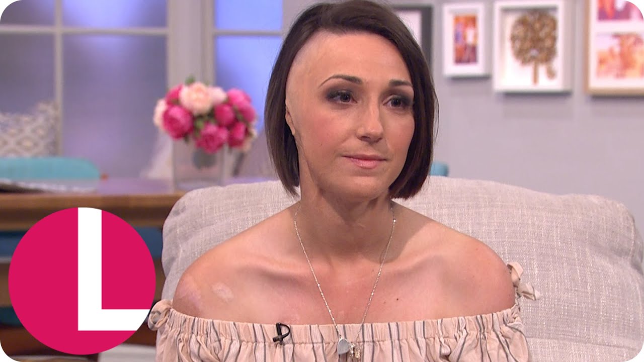 Acid Attack Survivor Adele Bellis Recalls Horrific Ordeal | Lorraine