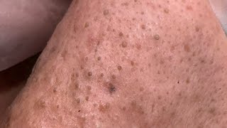 How To Use Anua Heartleaf Quercetinol Foam For Blackhead Removal
