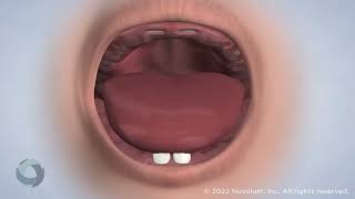 Frenectomy At Oc Oral Surgery In Mission Viejo, Ca