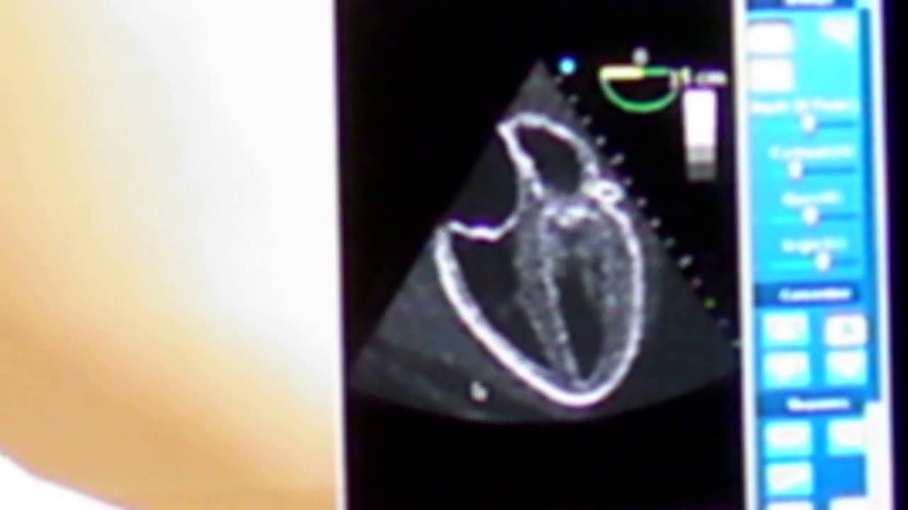 Transesophageal Echocardiography Tee Procedure YouTube transesophageal-echocardiography-tee-procedure-youtube