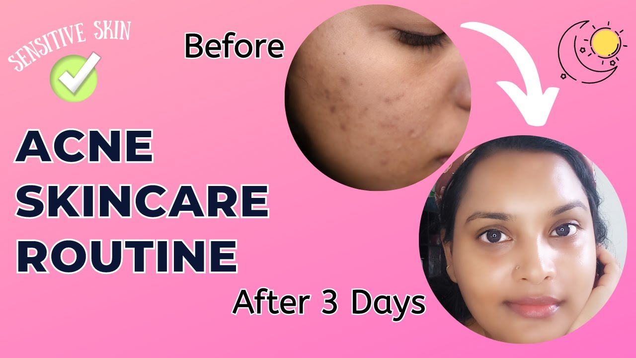 How I Got Rid Of My Acne With Just 2 Products - My Acne To Clear Skin ...