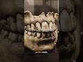 Chewing Gum from 5,700 Years Ago: A DNA Time Capsule of the Stone Age