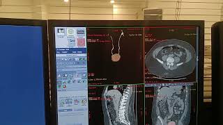 Celebrity CT Urogram , 3D Recon Wealth