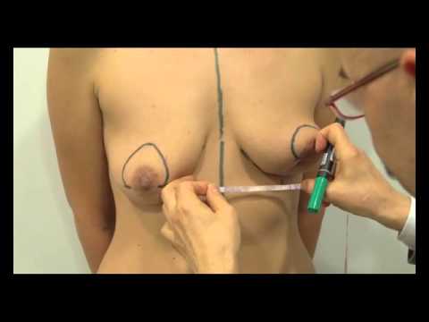 Video: Anastasia na neus- en mammoplastie