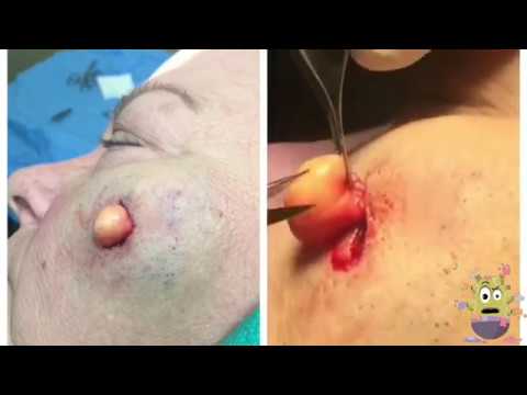 Big Pilar Cyst Removal On Cheek!!  │ How To Remove Acne Easy Part 