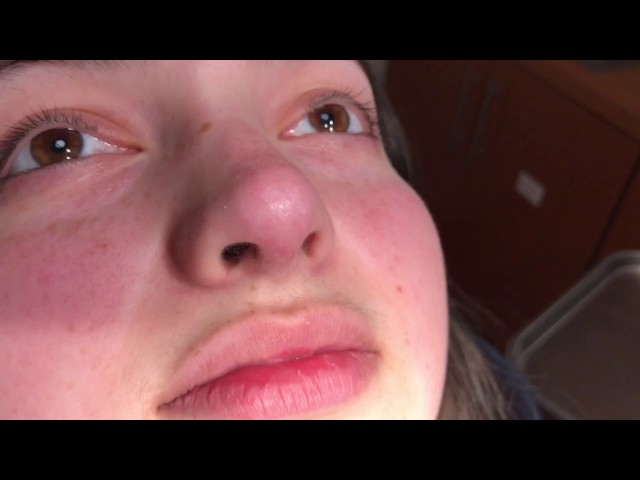 Rhinoplasty Close-Up Incision Video in Dallas, TX