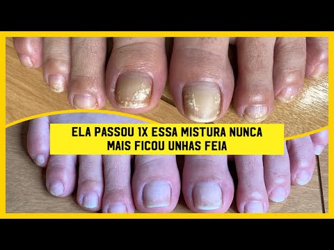 Vídeo: De quem as unhas dos pés ficam amarelas?