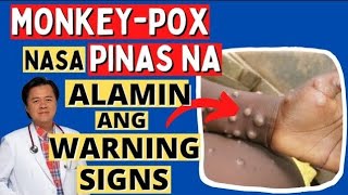 Monkey-pox Nasa Pinas Na. Alamin Warning Signs - Payo ni Doc Willie Ong