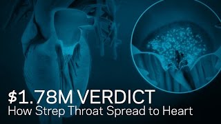 $1.78M Verdict: Animation Shows How Strep Spread to Heart