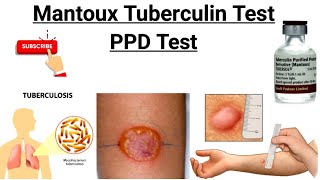 Mantoux Test || Tuberculin  Skin Test || PPD Test || Purified protein derivative