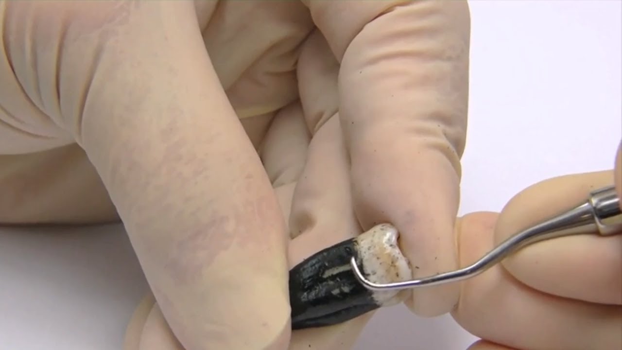 Comparison of Hand and Ultrasonic Scaling Stroke Width - Scaling and Root Planing