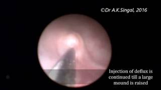 Deflux Injection Treatment For Vesicoureteric Reflux Vur In A Child- Dr A.k.singal, Mumbai, India