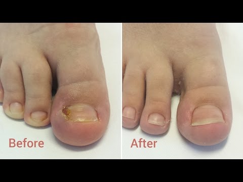 Unghia incarnata | The ingrown toenail | Before & After