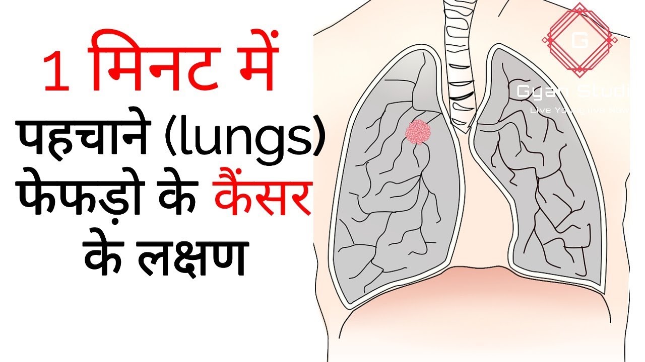 1मिनिट में पहचाने आपको फेफड़ों का कैंसर है या नहीं।फेफड़ों में कैंसर के