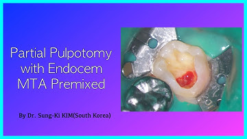 Partial pulpotomy with Endocem MTA Premixed