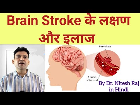 Brain stroke Brain Haemorrhage Symptoms and treatment #drniteshraj haemorrhage,CVA infarct in Hindi