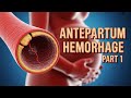 136. Antepartum Hemorrhage (Part 1) USMLE Step 2 CK