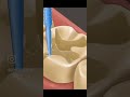 علاج تسوس الاسنان حشو الاسنان حشوات حشو العصب حشو الاسنان تسوس الاسنان تسوس علاج تسوس الاسنان حشو الاسنان حشوات حشو العصب حشو الاسنان تسوس الاسنان تسوس