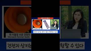 소아 응급내시경 이물질 제거