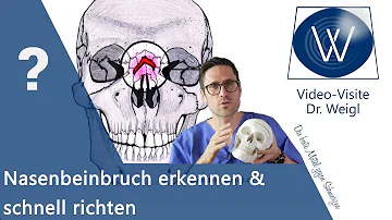 Wie lange kann sich ein Bruch verschoben?