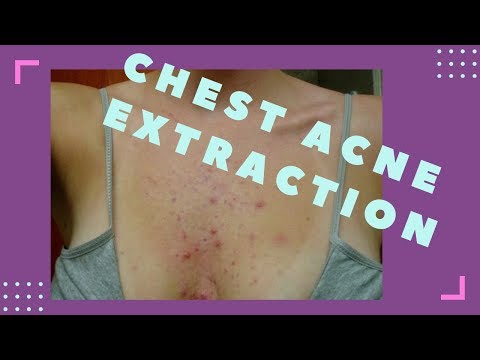 Chest Acne Whiteheads Extraction