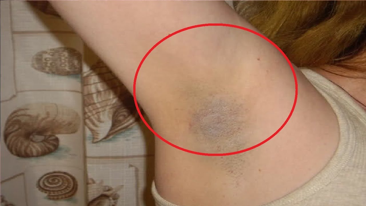 how to get rid of dark underarms fast home remedies - YouTube