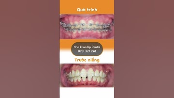 Hành trình LỘT XÁC nhờ niềng răng của Tú Như