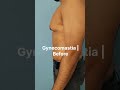 Gynecomastia | appearance at one month after procedure