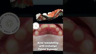 Invisalign Palatal Expander. Skeletal expansion for growing patients