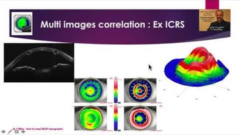 Simple Guide for reading AS OCT topography  MS39 Edition 2 part 2/2 by Dr Y.Rifay ( Phoenix 3.7 )