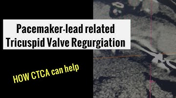 CT Coronary Angiogram and pacemaker-lead related tricuspid valve regurgitation (leaflet anatomy)