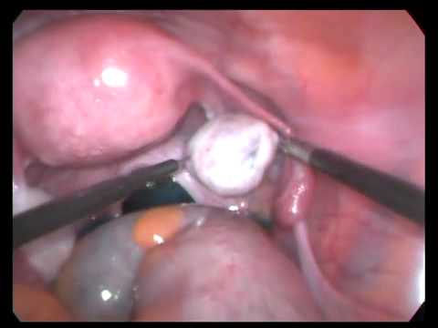 ovarian drilling laparoscopic