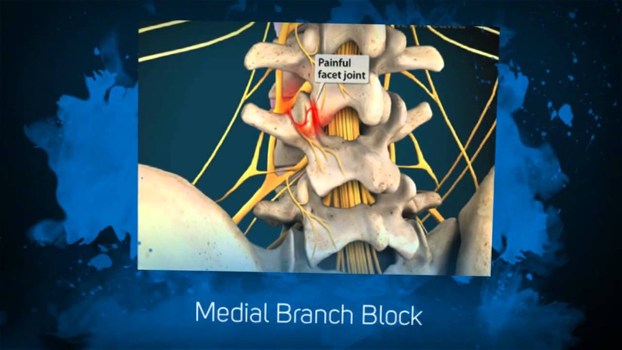 Dr. Kornick Riverside Spine Jacksonville (904) 3891010 Medial Branch