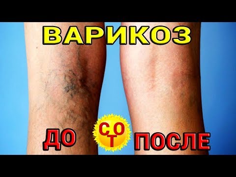 Папа избавился от варикоза за 2 месяца Варикоз и другое. Корень для здоровья. | вылечить | варикоза | татьяна | сделать | подарок | лечение | варикоз | своими | руками | орлова