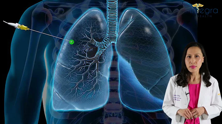Diagnosing Lung Cancer by early identification of pulmonary nodules. - DayDayNews