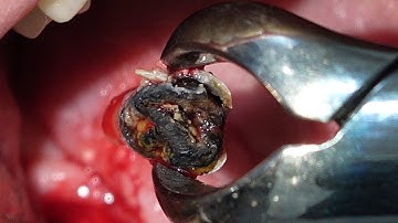 Big Tooth Cavity Removed | Wisdom Tooth Forcep Extraction in 4K.