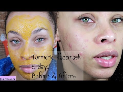 I TRIED TURMERIC FACE MASKS FOR  DAYS - RESULTS - ACNE PRONE SKIN