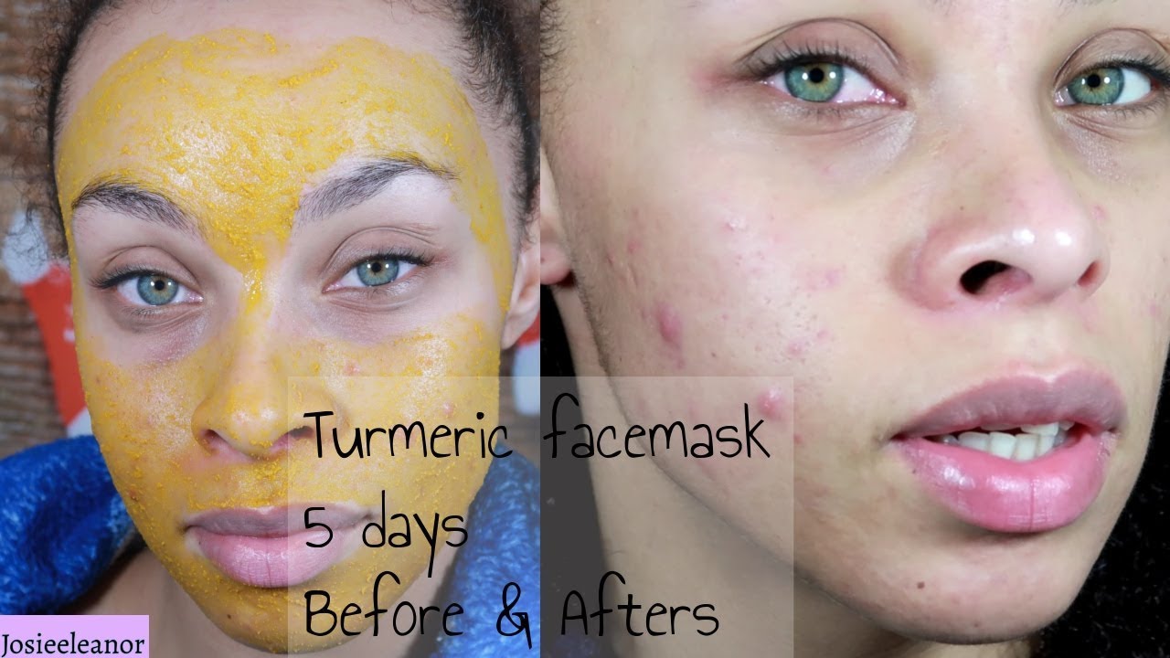 I TURMERIC FACE FOR 5 - RESULTS - ACNE SKIN - YouTube