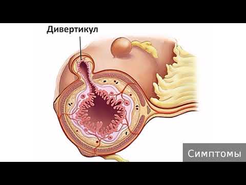 Дивертикул пищевода. Как лечить дивертикул пищевода.