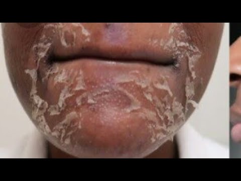 glycolic-acid-cream-|-pigmentation-removal-|-wrinkles-|-acne-scar-|-open-pores-|-brijwasi-girl